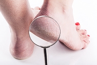 Causes and Treatment of Cracked Heels